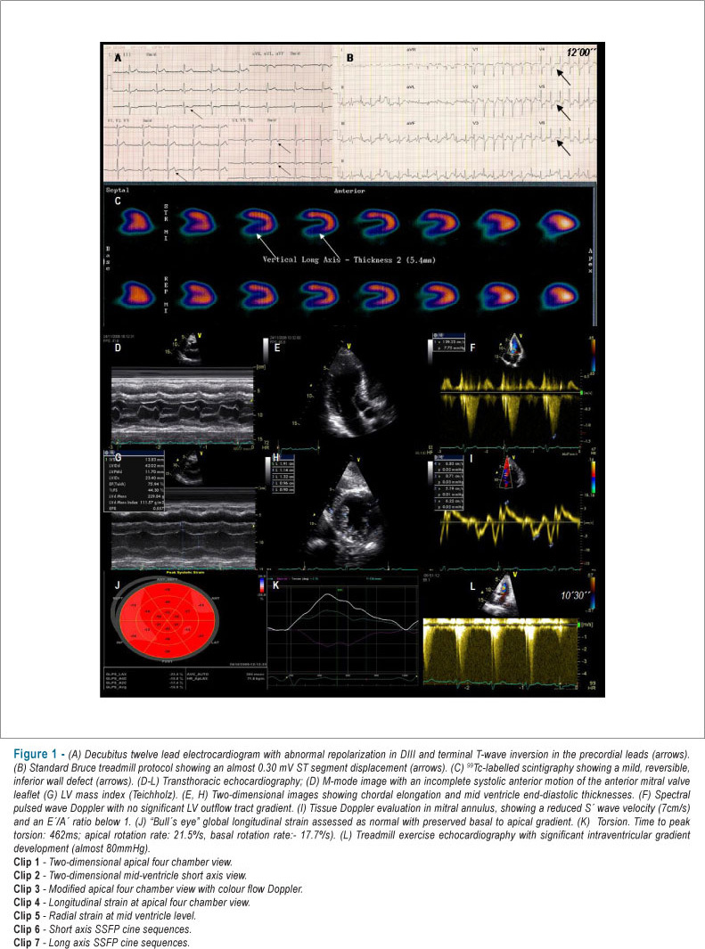 Latent obstructive hypertrophic cardiomyopathy: is echocardiography enough?