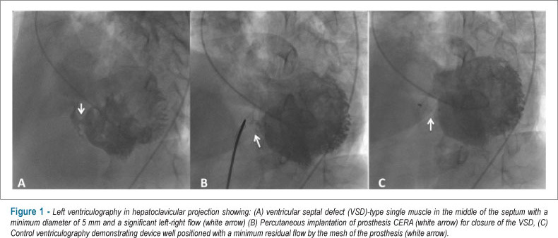 Occlusion of post-myocardial infarction ventricular defect with prosthesis CERA