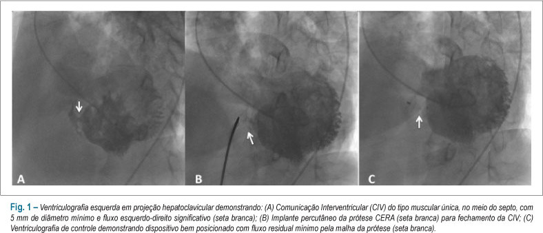 Oclusão de comunicação interventricular pós-infarto com prótese percutânea CERA