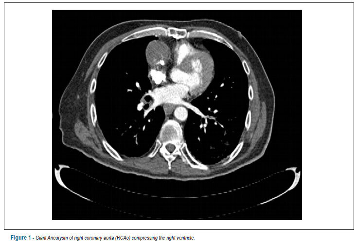 Giant aneurysm of saphenous vein bypass for right coronary after angioplasty