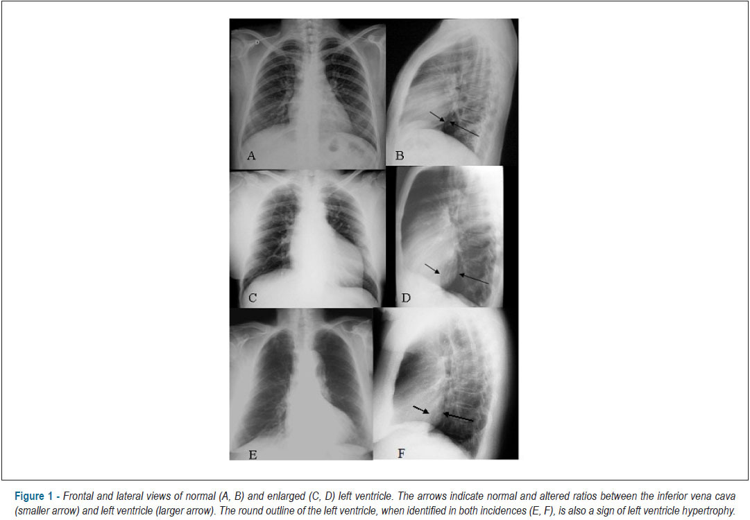 Accuracy of chest radiography plus electrocardiogram in diagnosis of hypertrophy in hypertension
