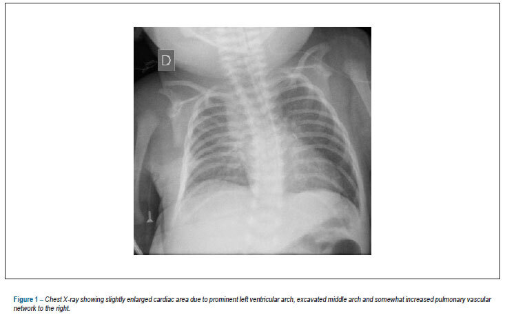 Case 6/2012: newborn with pulmonary atresia, ventricular septal defect and double aortic arch
