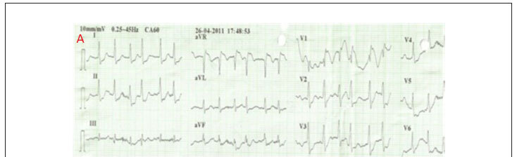 ST-segment elevation in pulmonary thromboembolism