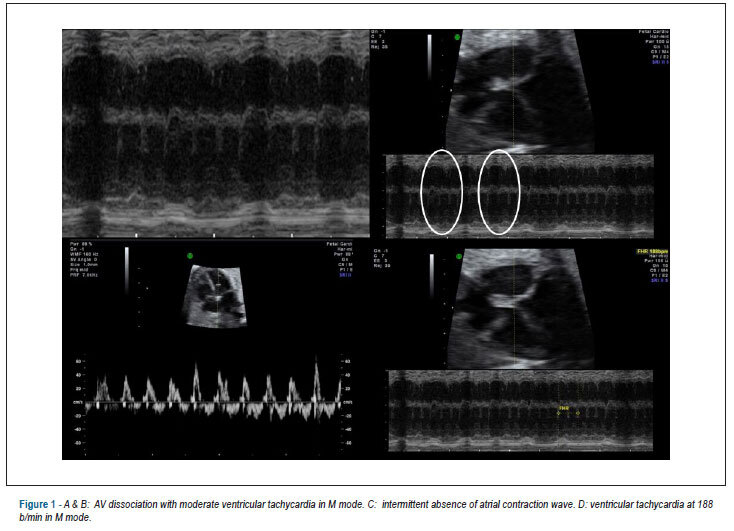 Prenatal management and outcome of junctional ectopic tachycardia and hydrops