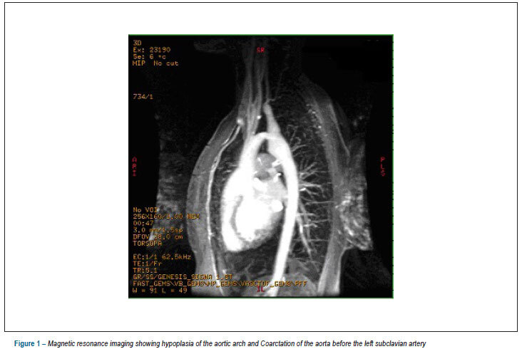 Variant technique of extra-anatomic aortic bypass in aortic recoarctation