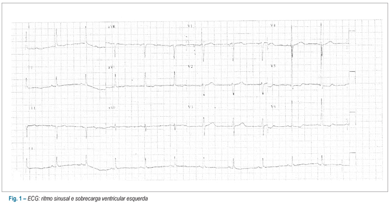 Caso 05/12: mulher de 67 anos portadora de hipertensão arterial e fibrilação atrial com choque seguido de parada cardíaca sem pulso dois meses após cirurgia para correção de aneurisma de aorta ascendente