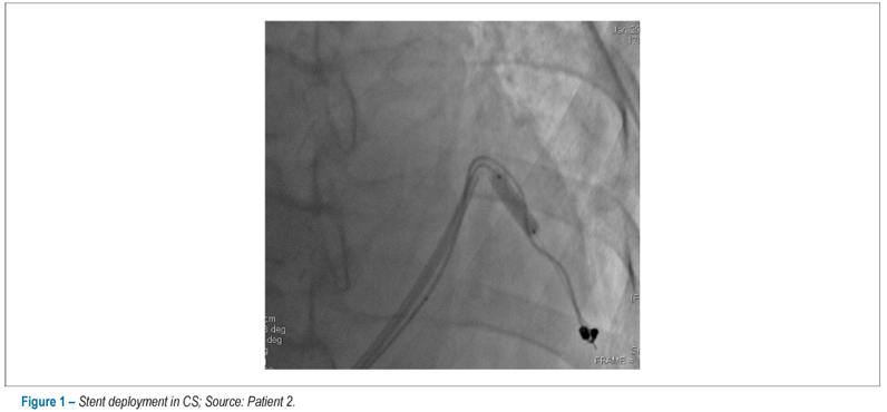 Supporting stent of coronary sinus lead in cardiac resynchronization: report of 5 cases