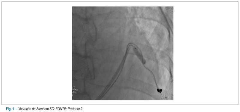 Stent de sustentação de eletrodo de seio coronariano na ressincronização cardíaca: relato de 5 casos