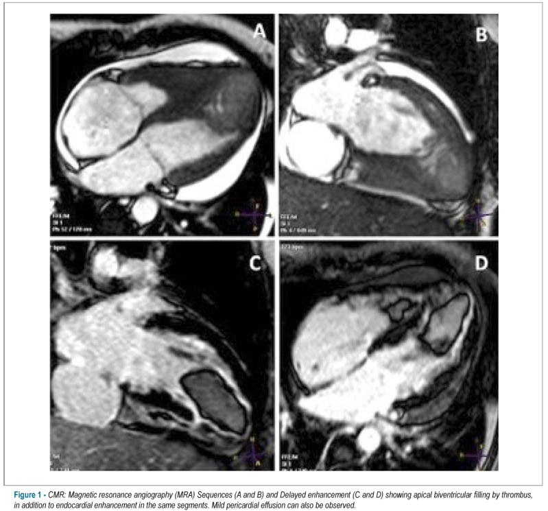 Biventricular thrombus and endomyocardial fibrosis in antiphospholipid syndrome