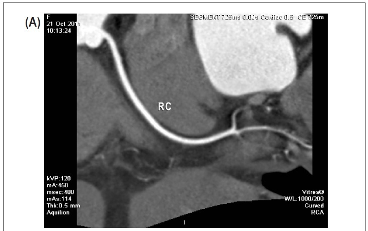 Coronary tomography for predicting adverse events in patients with suspected coronary disease