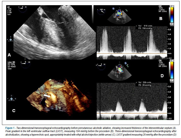Multidisciplinary interaction in invasive cardiology: septal alcoholization