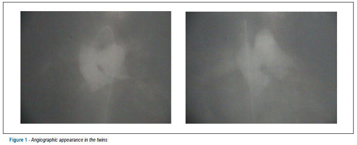 Surgical repair of aortopulmonary window in twins: a case report