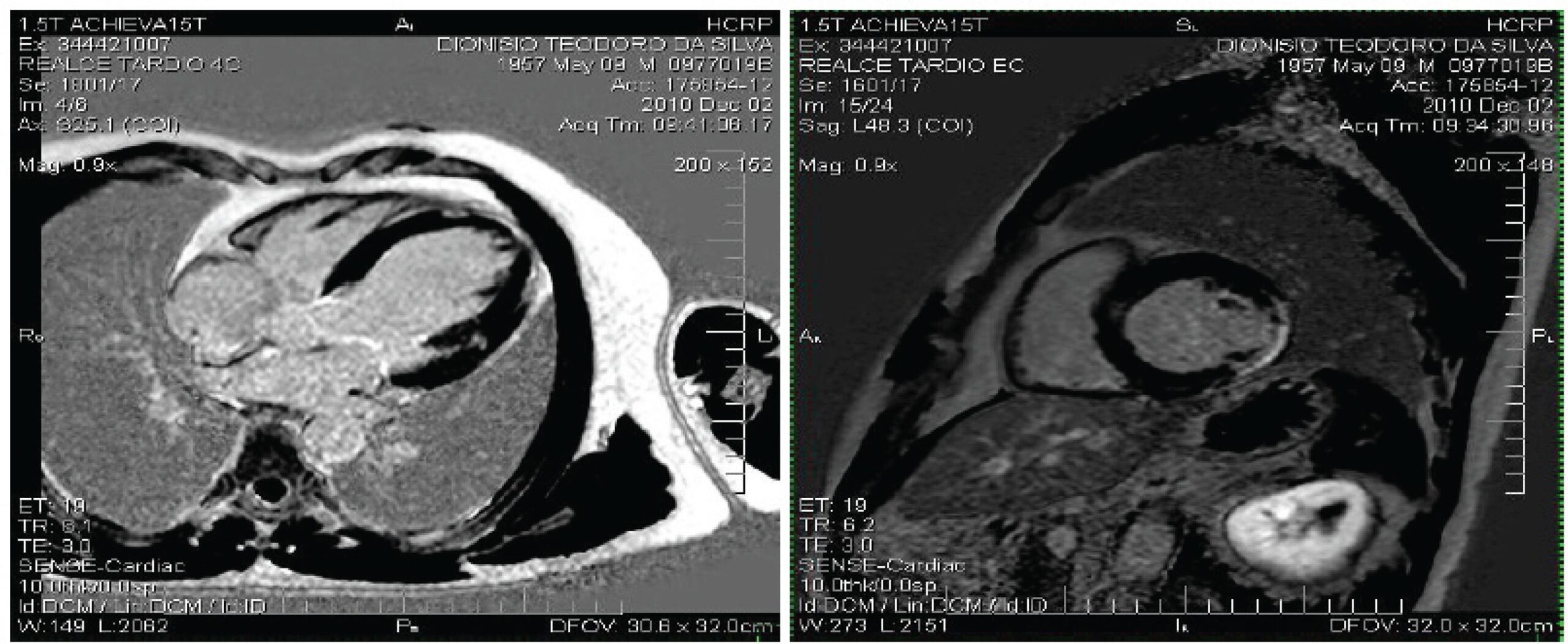 ERRATUM: Chagas Disease Cardiomyopathy