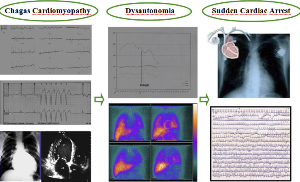 Chagas patient, male, 30 years old; ECG showed right bundle branch block + left anterior hemiblock + unsustainable monomorphic ventricular tachycardia ; echo / chest radiography revealed dilated cardiomyopathy; TILT test showed dysautonomy; myocardial scintigraphy with MIBG showed sympathetic ventricular denervation (dysautonomia); 24h-Holter highlighted several episodes of unsustainable monomorphic ventricular tachycardia. High-risk patient for sudden death, implanted ICD ECG: electrocardiography; ICD: implantable cardioverter-defibrillator.