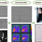 Chagas patient, male, 30 years old; ECG showed right bundle branch block + left anterior hemiblock + unsustainable monomorphic ventricular tachycardia ; echo / chest radiography revealed dilated cardiomyopathy; TILT test showed dysautonomy; myocardial scintigraphy with MIBG showed sympathetic ventricular denervation (dysautonomia); 24h-Holter highlighted several episodes of unsustainable monomorphic ventricular tachycardia. High-risk patient for sudden death, implanted ICD ECG: electrocardiography; ICD: implantable cardioverter-defibrillator.