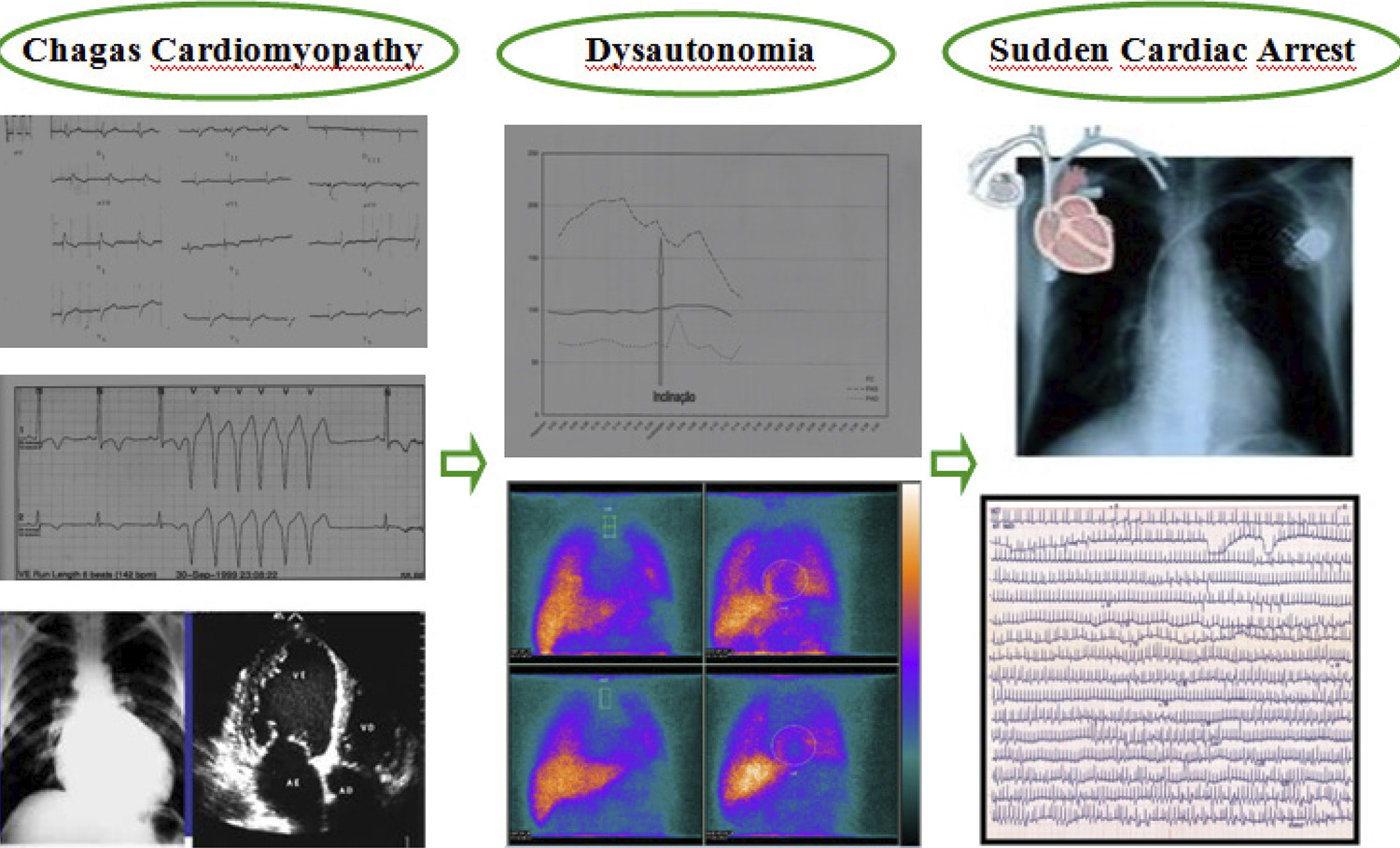 Dysautonomic Arrhythmogenesis: A Working Hypothesis in Chronic Chagas Cardiomyopathy