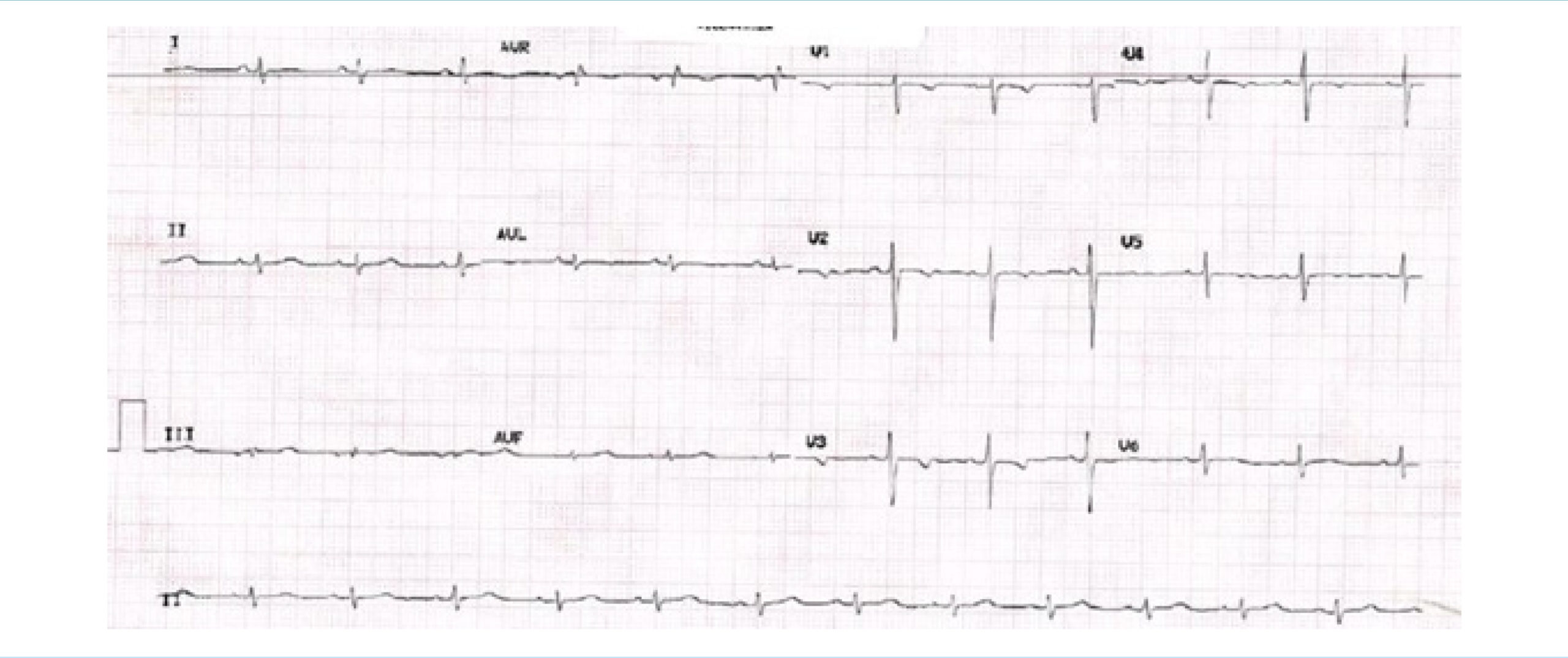Beyond Atherothrombotic Disease in Acute Coronary Syndrome