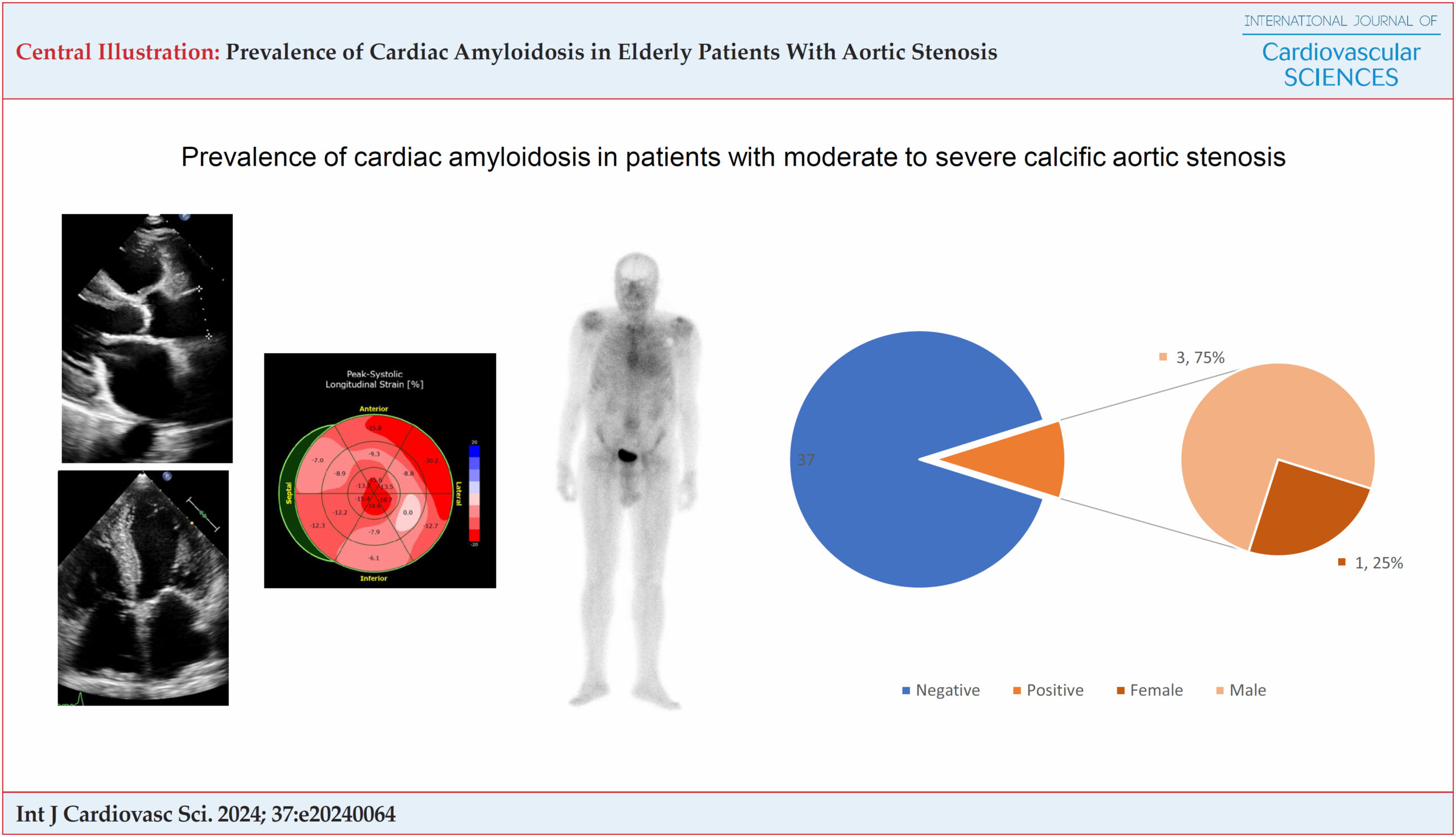 Prevalence of Cardiac Amyloidosis in Elderly Patients With Aortic Stenosis