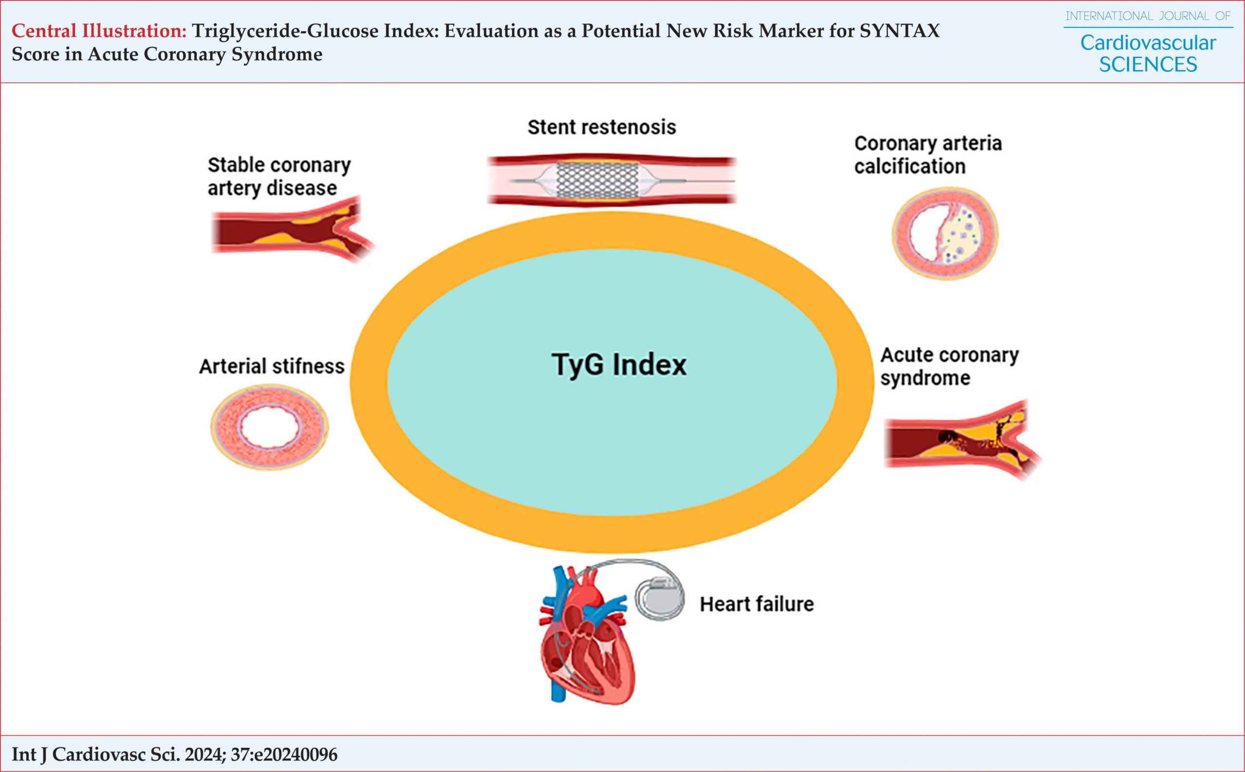 Triglyceride-Glucose Index: Evaluation as a Potential New Risk Marker for SYNTAX Score in Acute Coronary Syndrome
