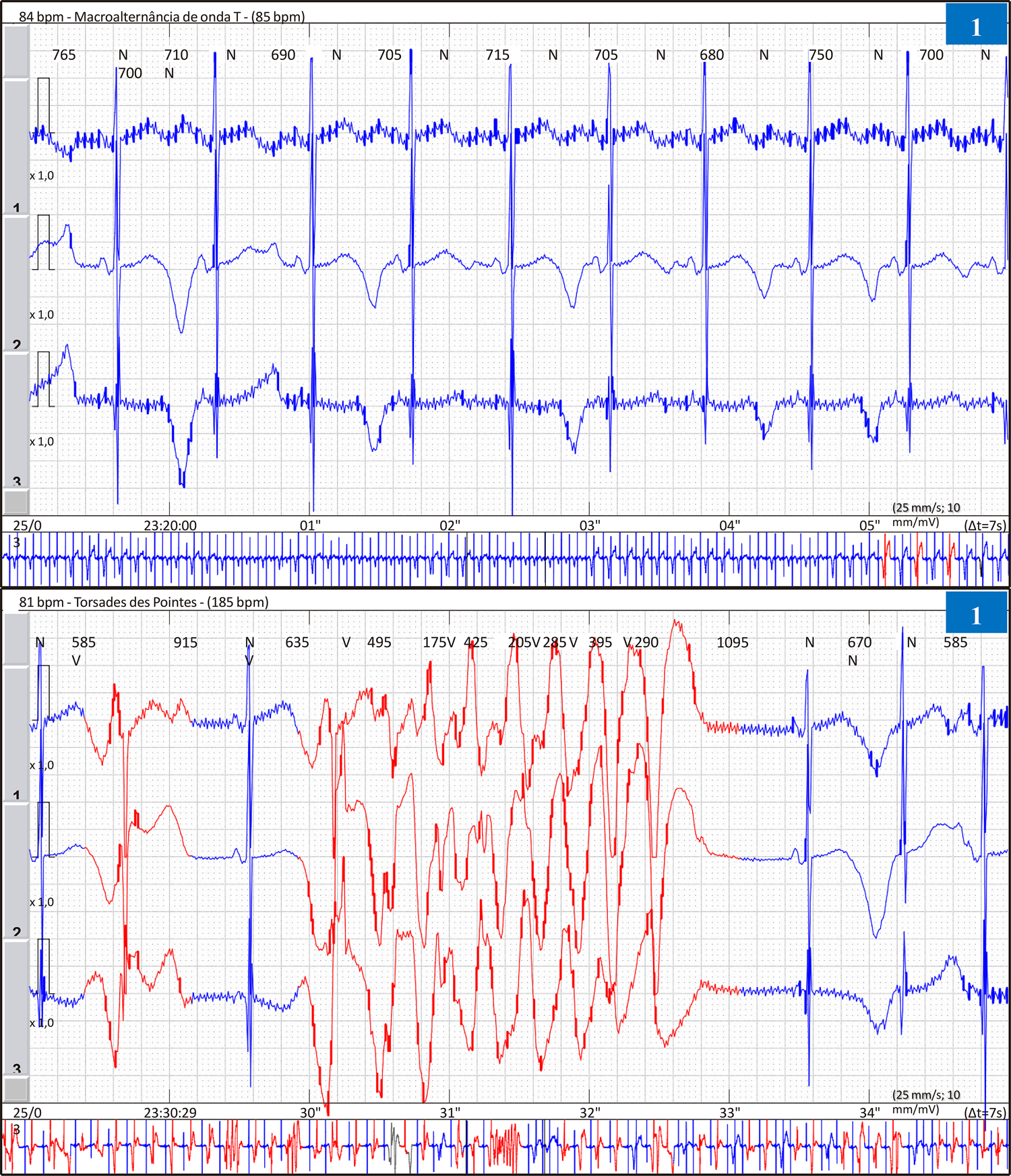Mexiletine in The Treatment of Long QT Syndrome Type 2 in Infants: A Case Report