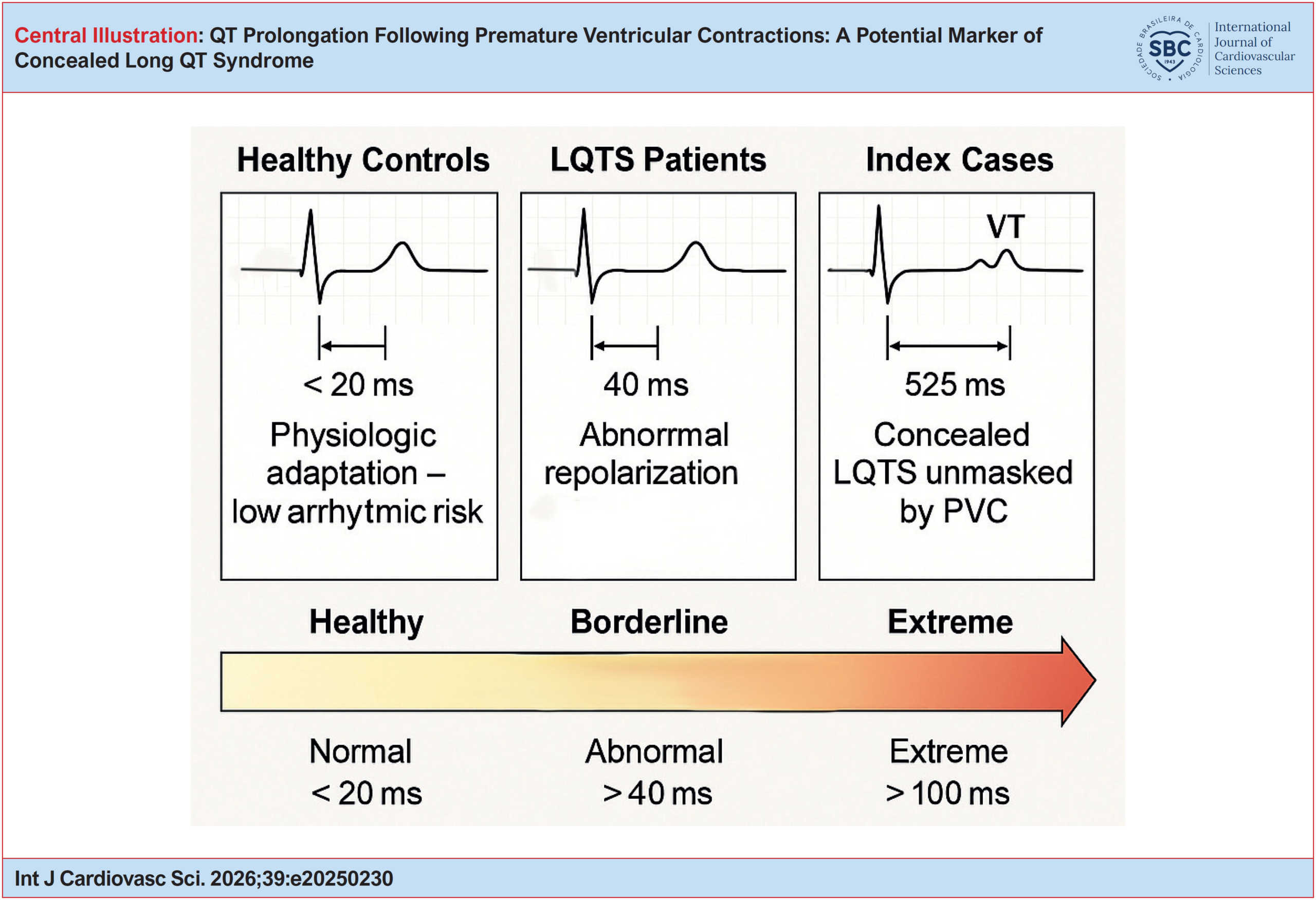 QT Prolongation Following Premature Ventricular Contractions: A Potential Marker of Concealed Long QT Syndrome