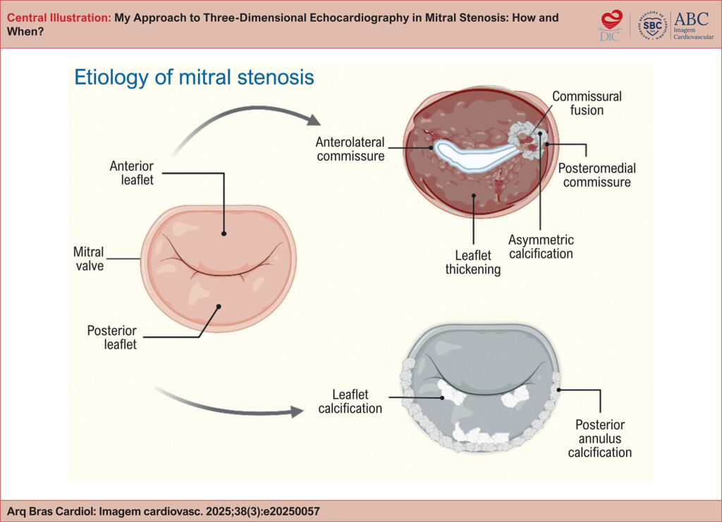 Schematic illustration of the anatomical manifestations of mitral stenosis according to etiology. On the left, a normal mitral valve. In the upper right quadrant, the rheumatic pattern shows diffuse leaflet thickening with fusion and asymmetric calcification of one commissure. In the lower right quadrant, the degenerative calcific pattern shows extensive calcium deposition in the posterior annulus and the leaflet bases.