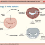 Schematic illustration of the anatomical manifestations of mitral stenosis according to etiology. On the left, a normal mitral valve. In the upper right quadrant, the rheumatic pattern shows diffuse leaflet thickening with fusion and asymmetric calcification of one commissure. In the lower right quadrant, the degenerative calcific pattern shows extensive calcium deposition in the posterior annulus and the leaflet bases.