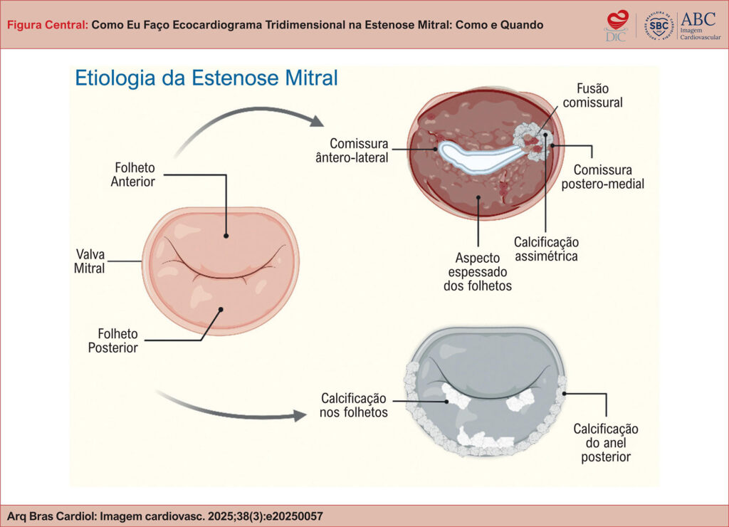 Ilustração esquemática das manifestações anatômicas da estenose mitral de acordo com a etiologia. À esquerda, valva mitral sem alterações. No quadrante superior direito, padrão reumático evidenciando espessamento difuso dos folhetos com fusão e calcificação assimétrica de uma das comissuras. No quadrante inferior direito, padrão degenerativo calcífico, com deposição extensa de cálcio no anel posterior e nas bases dos folhetos.