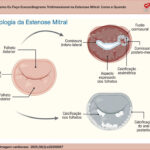 Ilustração esquemática das manifestações anatômicas da estenose mitral de acordo com a etiologia. À esquerda, valva mitral sem alterações. No quadrante superior direito, padrão reumático evidenciando espessamento difuso dos folhetos com fusão e calcificação assimétrica de uma das comissuras. No quadrante inferior direito, padrão degenerativo calcífico, com deposição extensa de cálcio no anel posterior e nas bases dos folhetos.