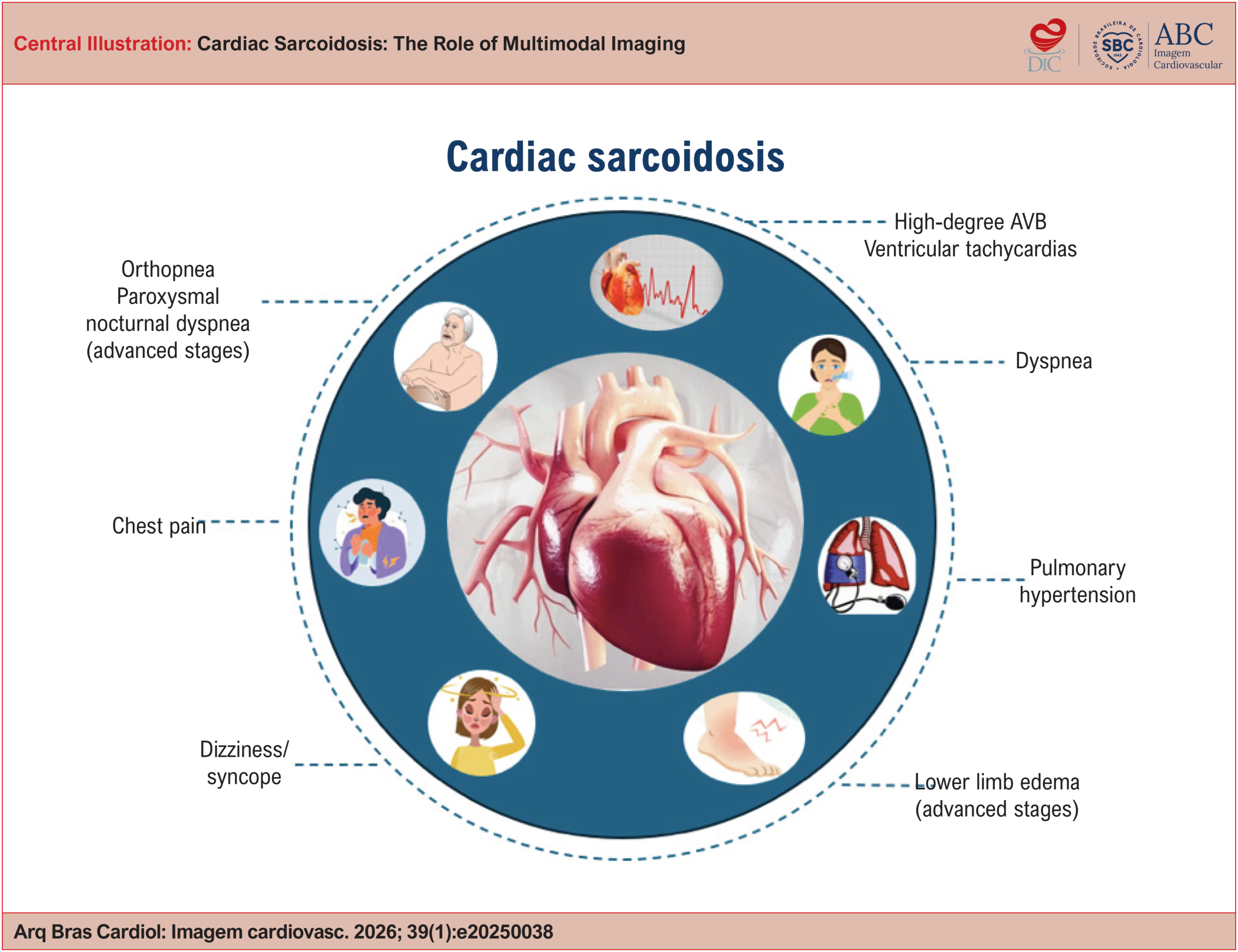 Cardiac Sarcoidosis: The Role of Multimodal Imaging