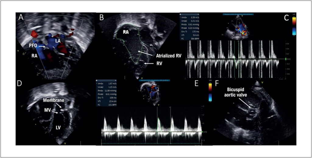 Newborn Infant – ABC CARDIOL