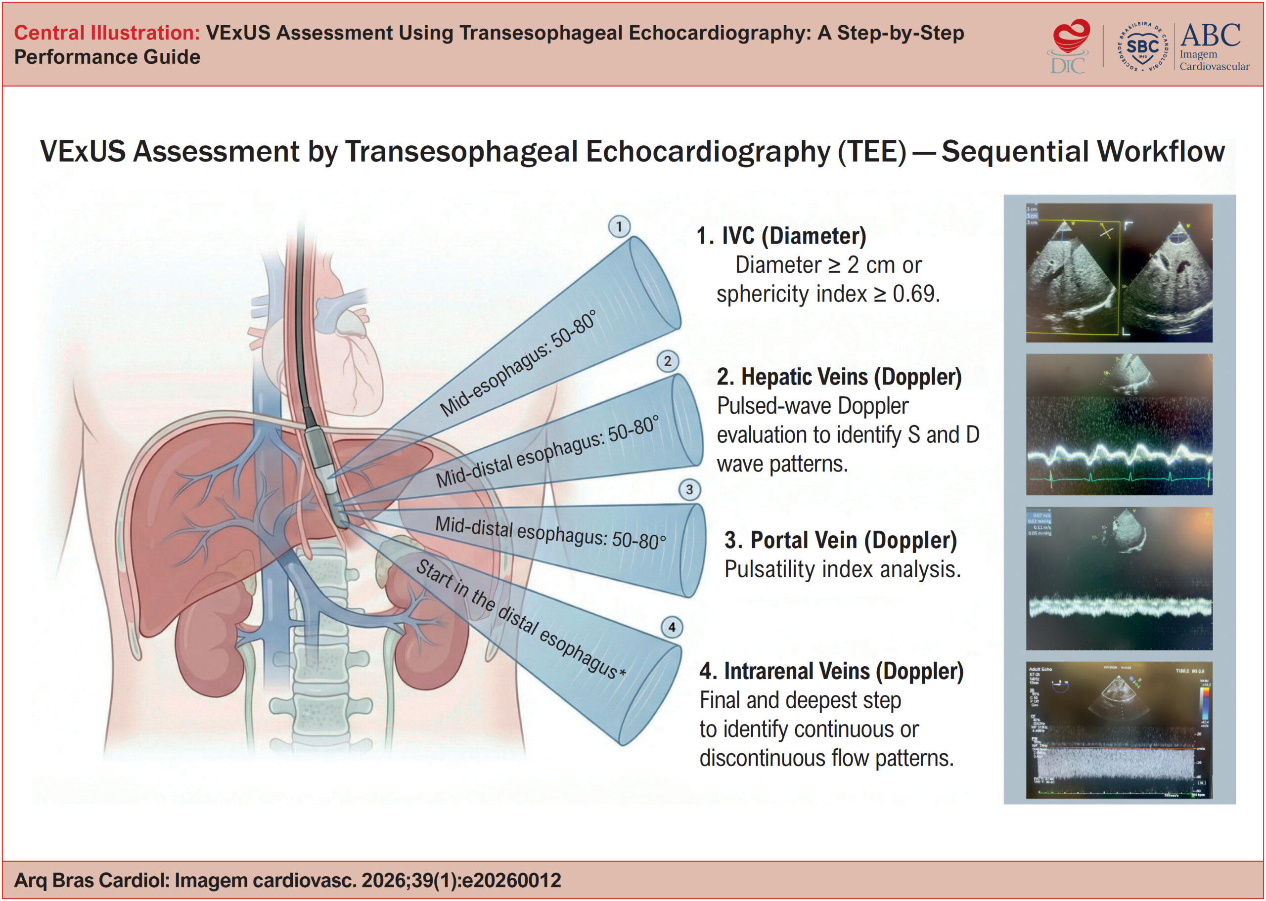 My Approach to VExUS Assessment Using Transesophageal Echocardiography: A Step-by-Step Performance Guide