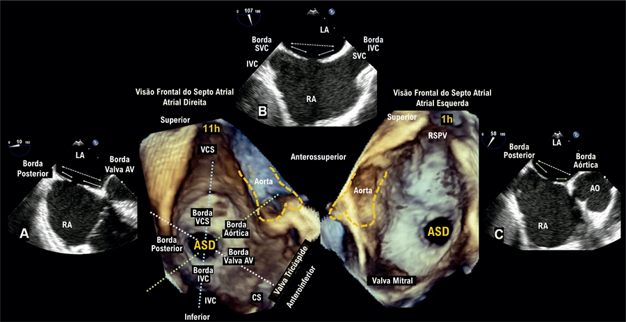 My Approach to Transcatheter Closure of Atrial Septal Defect: Step-by-Step and Current Contraindications