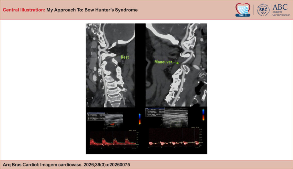 Top left: CT angiography of the vertebral artery at rest demonstrating normal opacification. Bottom left: Vertebral Doppler ultrasound at rest showing normal blood flow. Top right: CT angiography with contralateral neck rotation demonstrating arterial compression between C1 and C2. Bottom right: Doppler ultrasound with contralateral neck rotation demonstrating a staccato flow pattern.