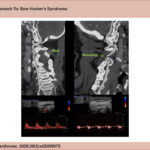 Top left: CT angiography of the vertebral artery at rest demonstrating normal opacification. Bottom left: Vertebral Doppler ultrasound at rest showing normal blood flow. Top right: CT angiography with contralateral neck rotation demonstrating arterial compression between C1 and C2. Bottom right: Doppler ultrasound with contralateral neck rotation demonstrating a staccato flow pattern.