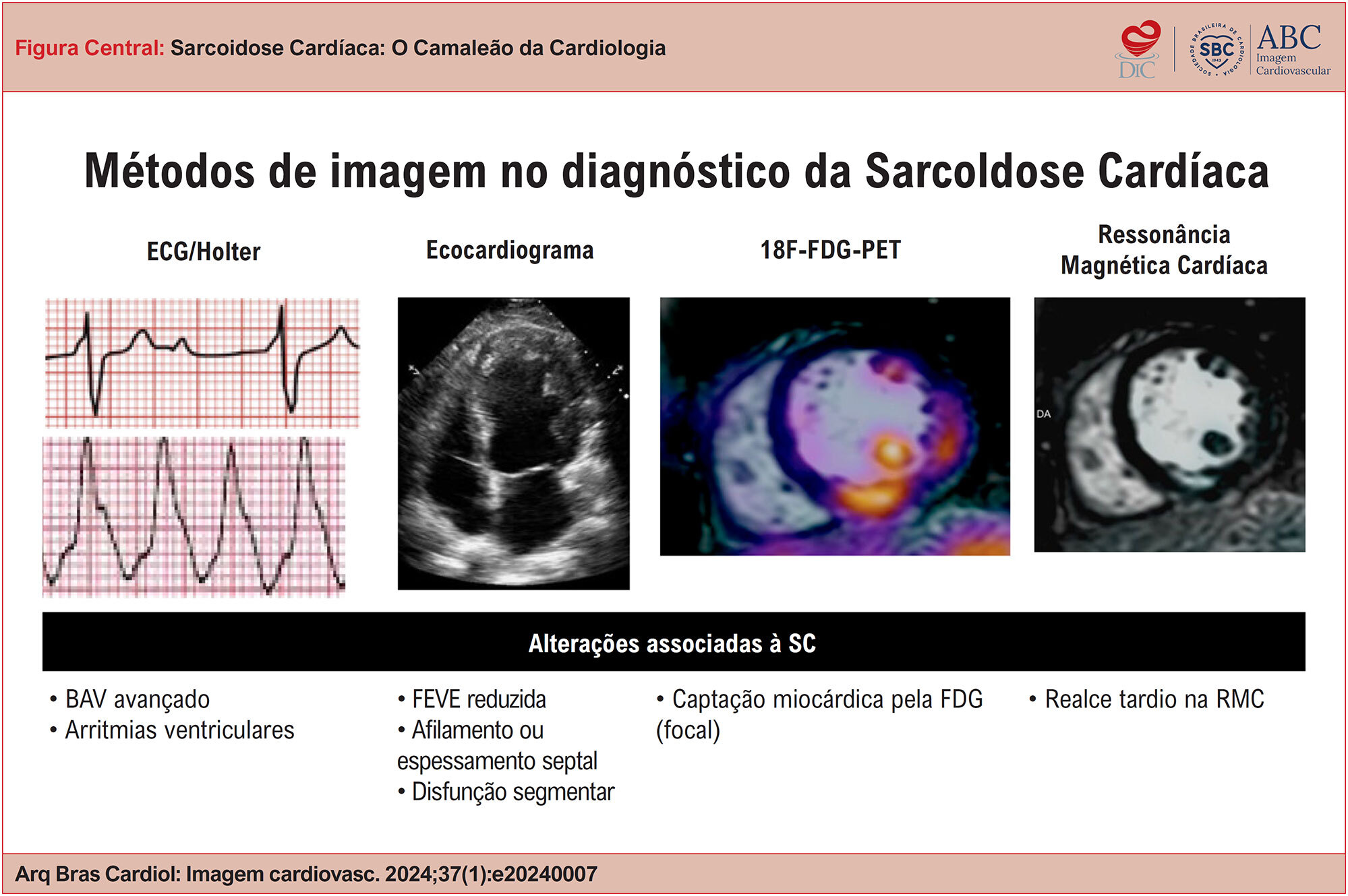Sarcoidose Cardíaca: O Camaleão da Cardiologia