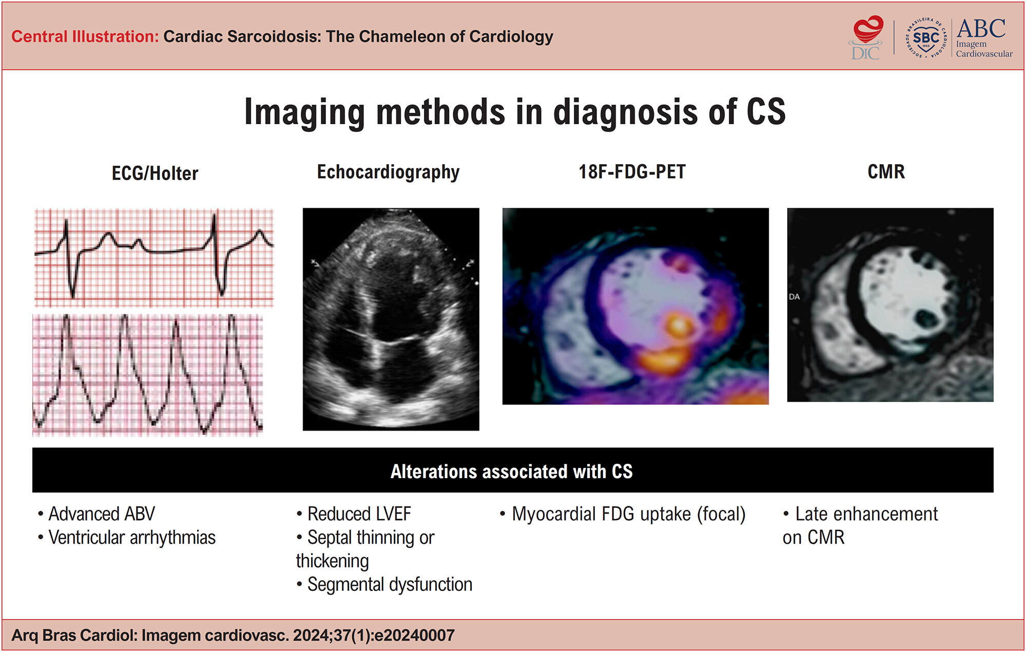 Cardiac Sarcoidosis: The Chameleon of Cardiology