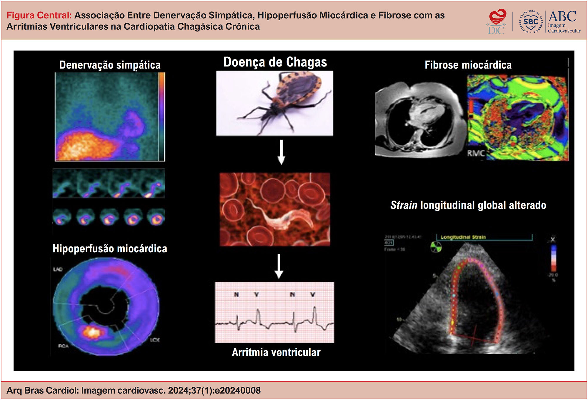Associação Entre Denervação Simpática, Hipoperfusão Miocárdica e Fibrose com as Arritmias Ventriculares na Cardiopatia Chagásica Crônica