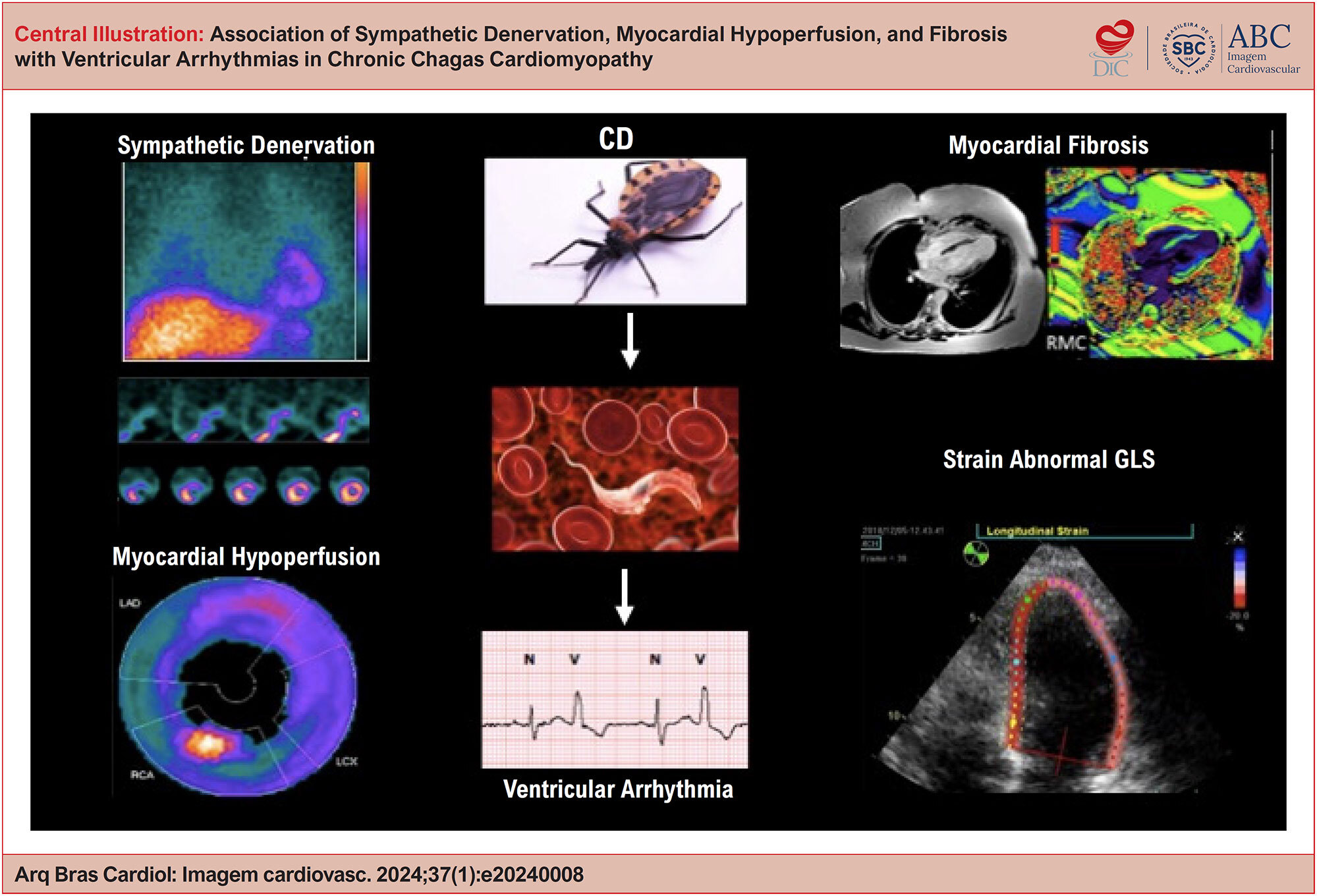 Association of Sympathetic Denervation, Myocardial Hypoperfusion, and Fibrosis with Ventricular Arrhythmias in Chronic Chagas Cardiomyopathy
