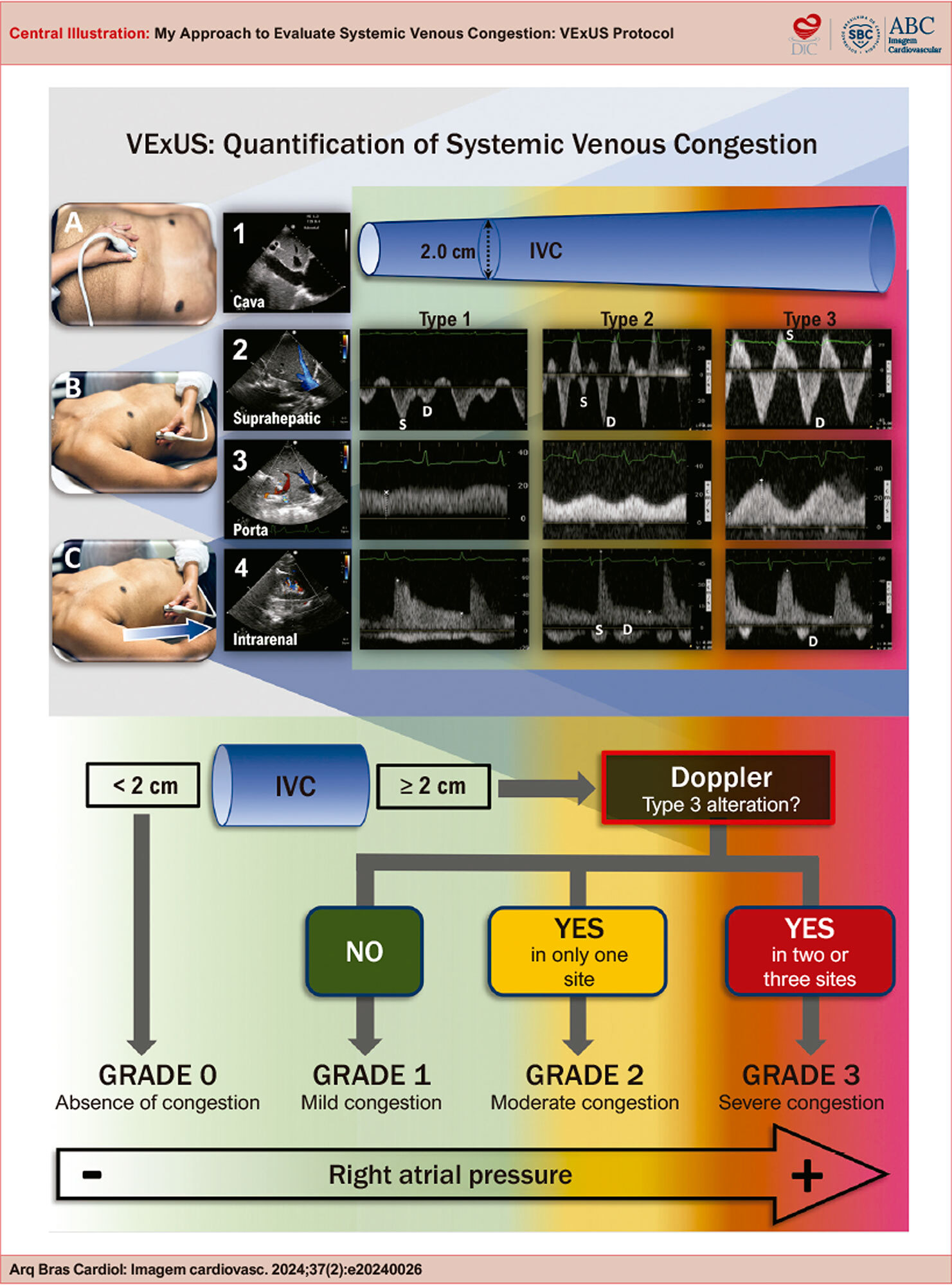 My Approach to Evaluate Systemic Venous Congestion: VExUS Protocol