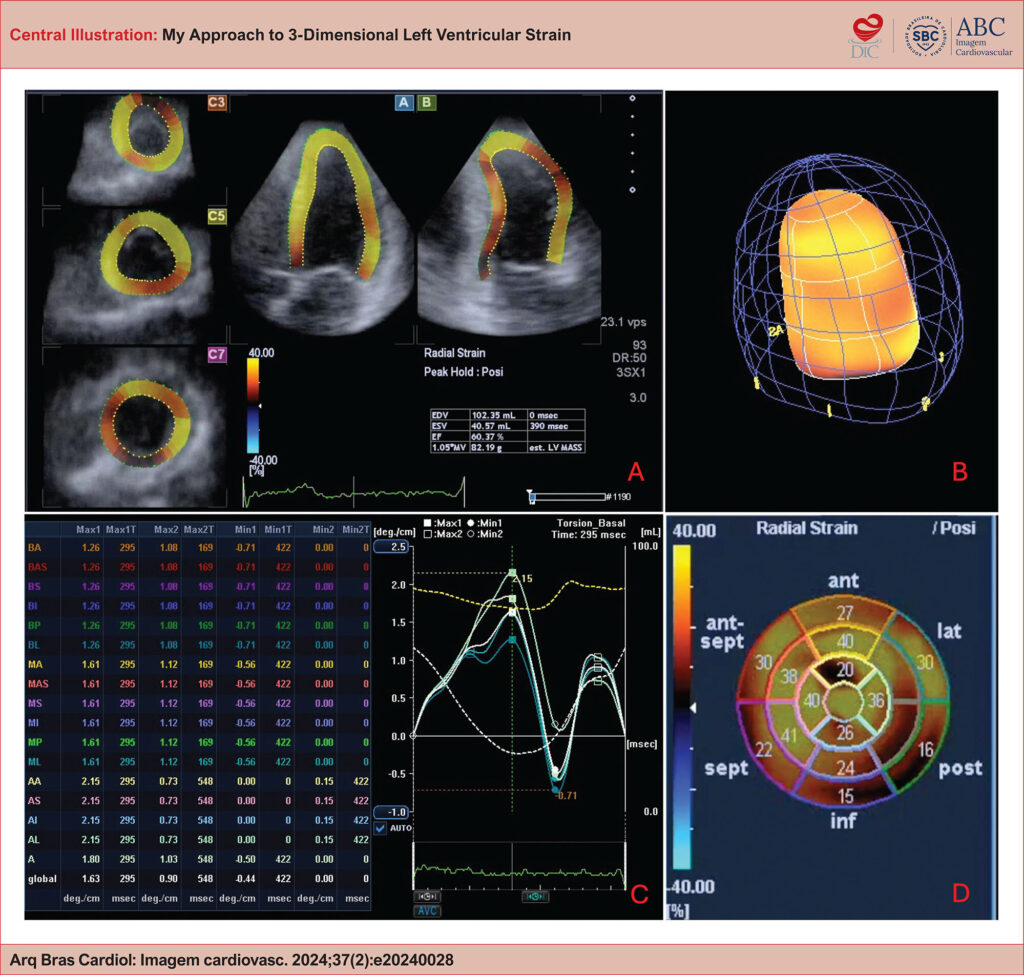 Example of sequence in left ventricular strain analysis using three-dimensional speckle tracking technique. A: Multiplanar image post three-dimensional acquisition, demonstrating tracking in the left ventricular myocardium. B: Illustrative image demonstrating evaluation of the full left ventricular volume. C: Curves and table with 3D strain values of all myocardial segments, in this case, an example of basal left ventricular twist calculation. D: Bull's Eye with 3D strain values of all myocardial segments, in this case, an example of left ventricular radial deformation.