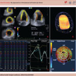 Example of sequence in left ventricular strain analysis using three-dimensional speckle tracking technique. A: Multiplanar image post three-dimensional acquisition, demonstrating tracking in the left ventricular myocardium. B: Illustrative image demonstrating evaluation of the full left ventricular volume. C: Curves and table with 3D strain values of all myocardial segments, in this case, an example of basal left ventricular twist calculation. D: Bull's Eye with 3D strain values of all myocardial segments, in this case, an example of left ventricular radial deformation.