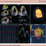 Exemplo de sequência na análise do strain do ventrículo esquerdo utilizando a técnica de speckle tracking tridimensional. A: Imagem multiplanar pós aquisição tridimensional, demonstrando o tracking no miocárdio ventricular esquerdo. B: Imagem ilustrativa demonstrando a avaliação do full volume ventricular esquerdo. C: Curvas e tabela com os valores do strain 3D de todos os segmentos miocárdico, no caso, exemplo do cálculo da torção basal do ventrículo esquerdo. D: Bull's Eye com os valores do strain 3D de todos os segmentos miocárdicos, no caso, exemplo da deformação radial do ventrículo esquerdo.