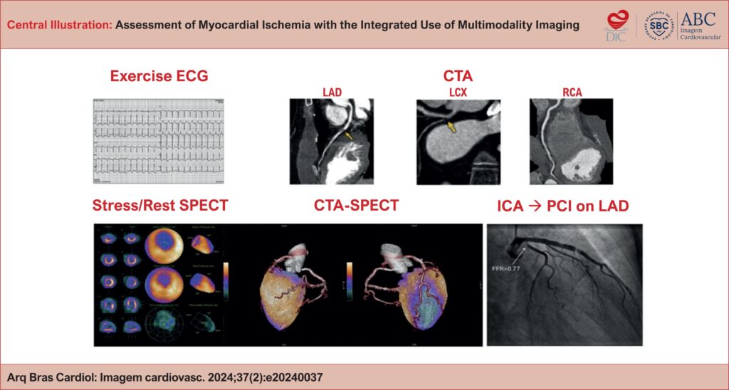 Example of multimodal assessment in the investigation of CAD in a patient with chronic coronary syndrome. CTA: coronary computed tomography angiography; ECG: electrocardiogram; ICA: invasive coronary angiography; LAD: left anterior descending artery; LCX: left circumflex artery; PCI: percutaneous coronary intervention; RCA: right coronary artery; SPECT: single-photon emission computed tomography.