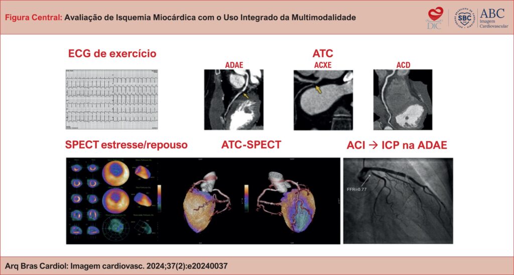 Exemplo de avaliação multimodal de investigação de DAC em paciente com síndrome coronariana crônica. ACD: artéria coronária direita; ACI: angiografia coronária invasiva; ACXE: artéria circunflexa esquerda; ADAE: artéria descendente anterior esquerda; ATC: angiotomografia coronariana; ECG: eletrocardiograma; ICP: intervenção coronária percutânea; SPECT: tomografia computadorizada por emissão de fóton único.
