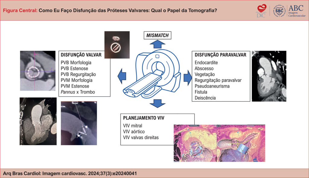 Utilidade da tomografia na disfunção das próteses valvares. PVB: Prótese valvar biológica, PVM: Prótese valvar metálica; VIV: valve-in-valve.