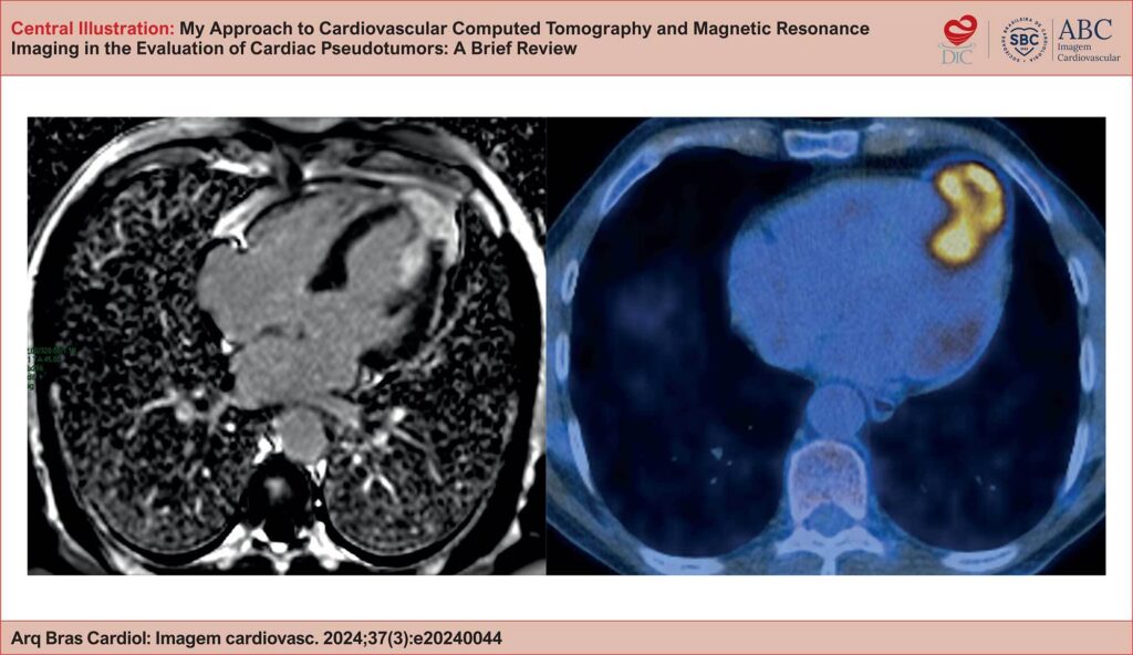 Male patient, 69 years old, undergoing investigation for a cardiac mass detected on echocardiography. Delayed-enhancement cardiac MRI in the 4-chamber plane (left) demonstrated an exophytic infiltrative lesion involving the apical portion of the left ventricle, extending to the papillary muscles. PET-CT fusion imaging (right) showed glycolytic hypermetabolism in the cardiac mass under investigation. After surgical resection of the lesion, histopathological findings confirmed the diagnosis of Rosai-Dorfman disease. CT: computed tomography; PET: positron emission tomography.