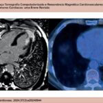 Paciente do sexo masculino, 69 anos, em investigação de massa cardíaca detectada no ecocardiograma. Imagens de RM cardíaca na sequência de RT no plano 4 câmaras (à esquerda) demonstram lesão infiltrativa exofítica envolvendo a porção apical do ventrículo esquerdo, com extensão para os músculos papilares. A fusão de imagens de PET-TC (à direita) evidenciam hipermetabolismo glicolítico na massa cardíaca em investigação. Após ressecção cirúrgica da lesão, os achados histopatológicos confirmaram o diagnóstico de Doença de Rosai-Dorfman. PET: tomografia por emissão de pósitrons; TC: tomografia computadorizada.