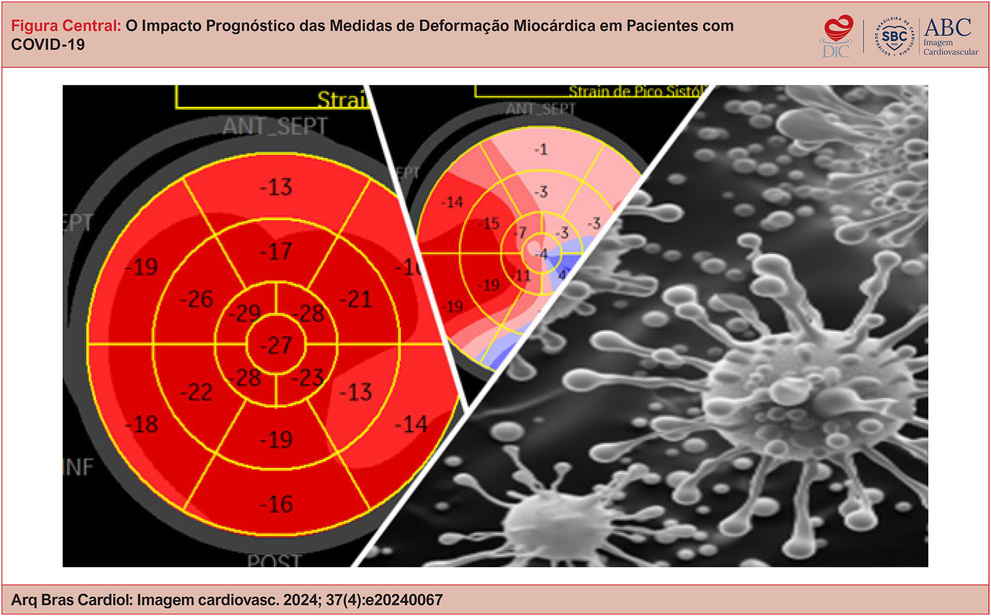O Impacto Prognóstico das Medidas de Deformação Miocárdica em Pacientes com COVID-19