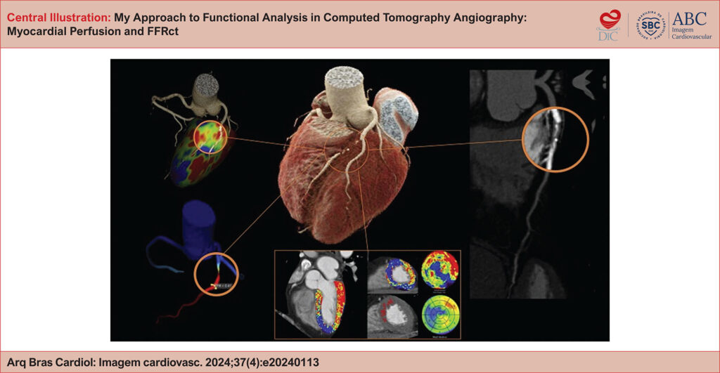 Coronary computed tomography angiography (CCTA) combining anatomy and functional assessment in the investigation of coronary disease. Central panel: three-dimensional reconstruction of the heart and coronary arteries. Upper left panel: 3D coronary tree with perfusion map of the left ventricle demonstrating the region irrigated by the affected artery. Lower left panel: fractional flow reserve derived from CTA (FFRct) with a value <0.80, compatible with flow-limiting stenosis. Lower panel: color-coded myocardial perfusion, demonstrating a perfusion defect under stress related to the region of the left anterior descending artery. Right panel: visual anatomical analysis by CCTA, demonstrating a sub-occlusive lesion in the left anterior descending artery.